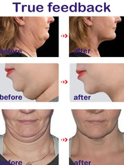 V-Shape Double Chin Fat Burning Cream